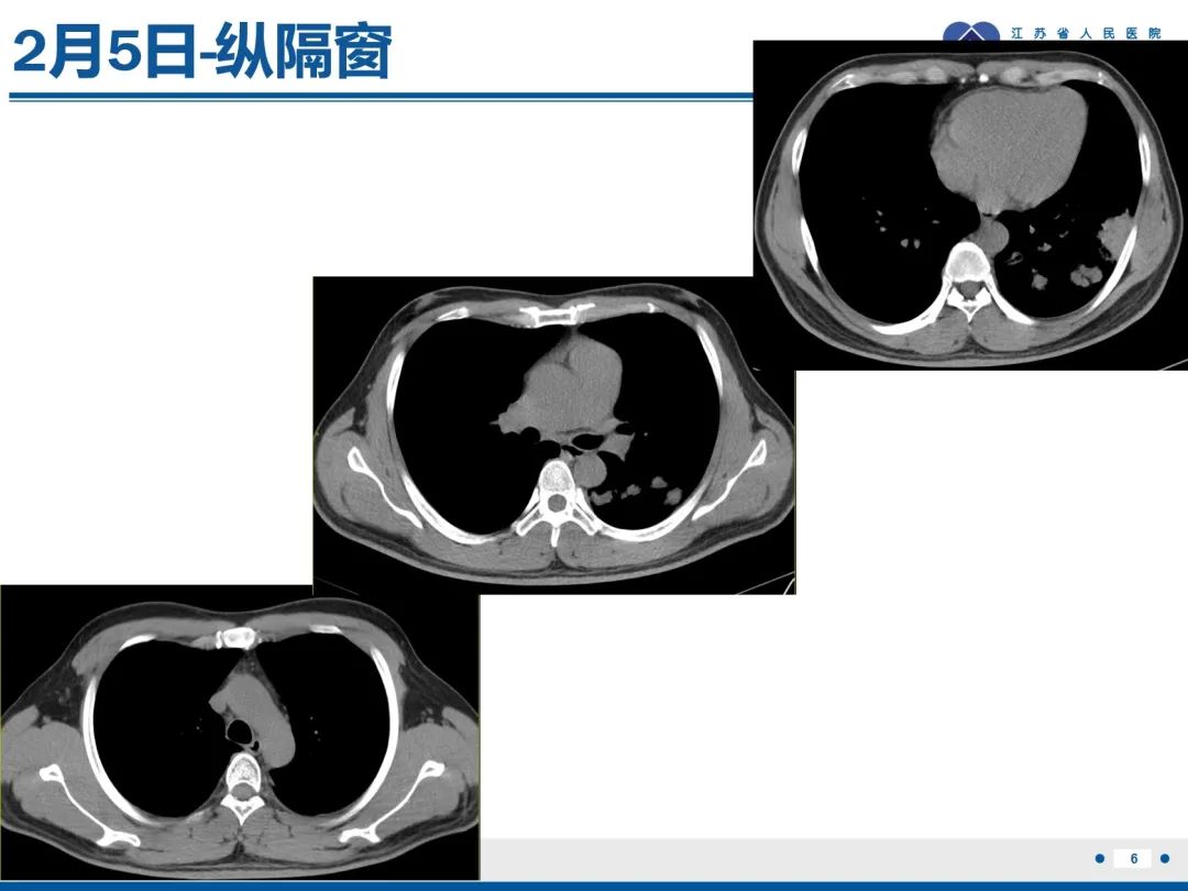 影像PPT - 【PPT】肺隐球菌病-7