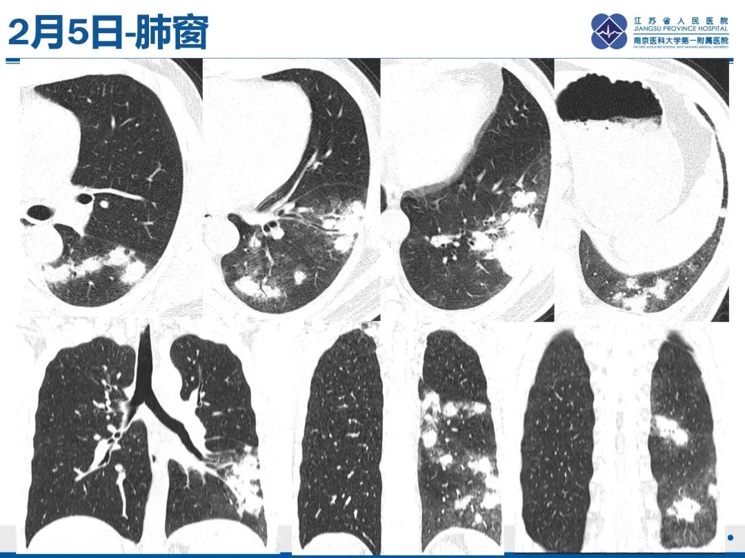 影像PPT - 【PPT】肺隐球菌病-6