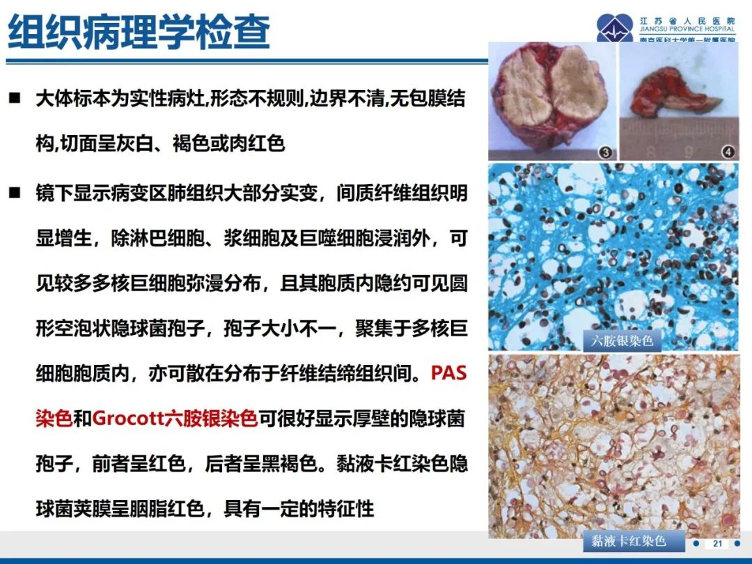 影像PPT - 【PPT】肺隐球菌病-22