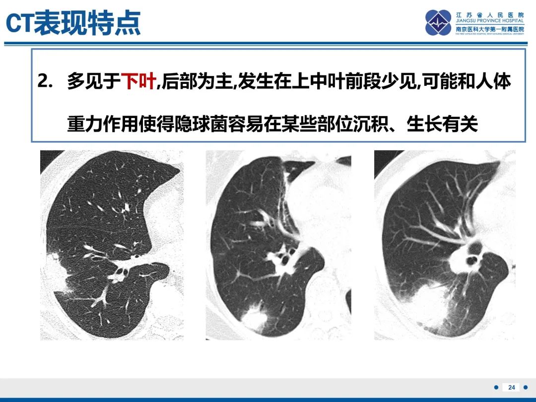 影像PPT - 【PPT】肺隐球菌病-25