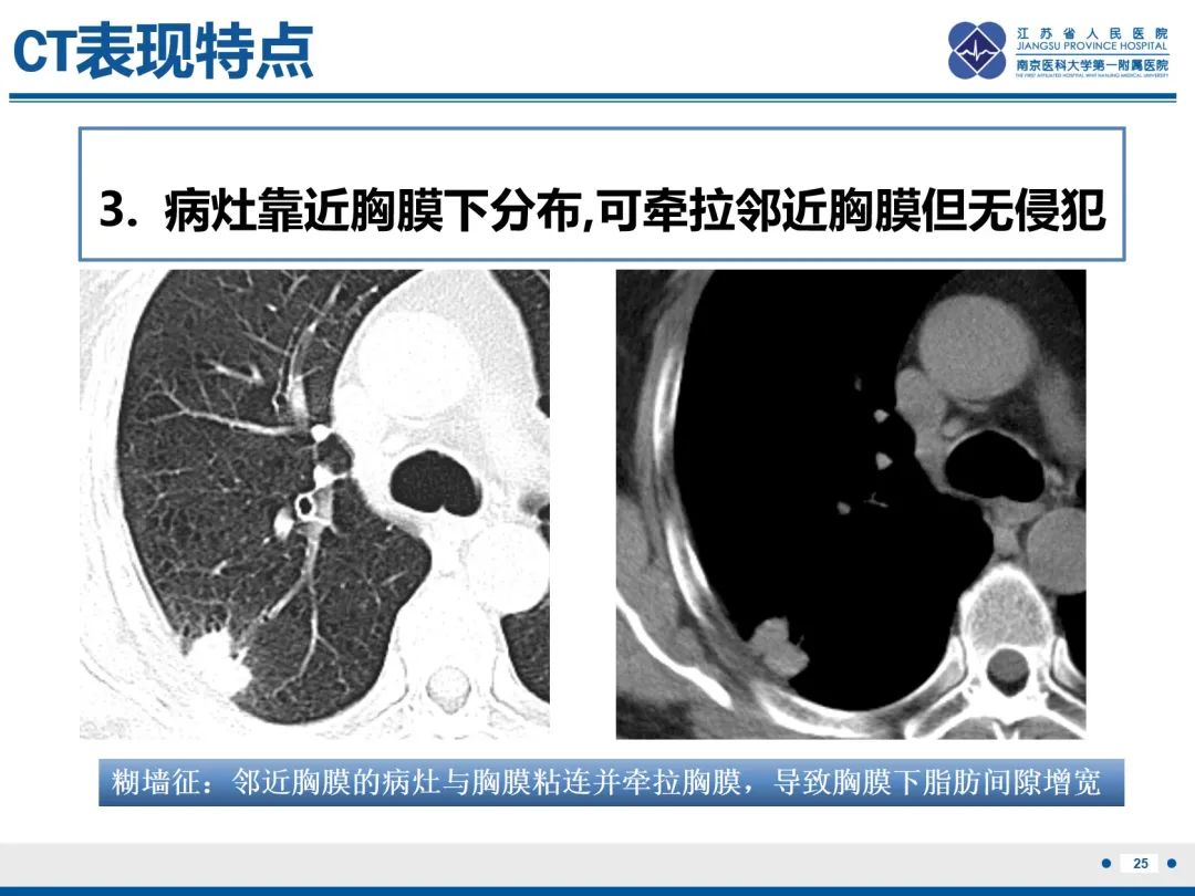影像PPT - 【PPT】肺隐球菌病-26