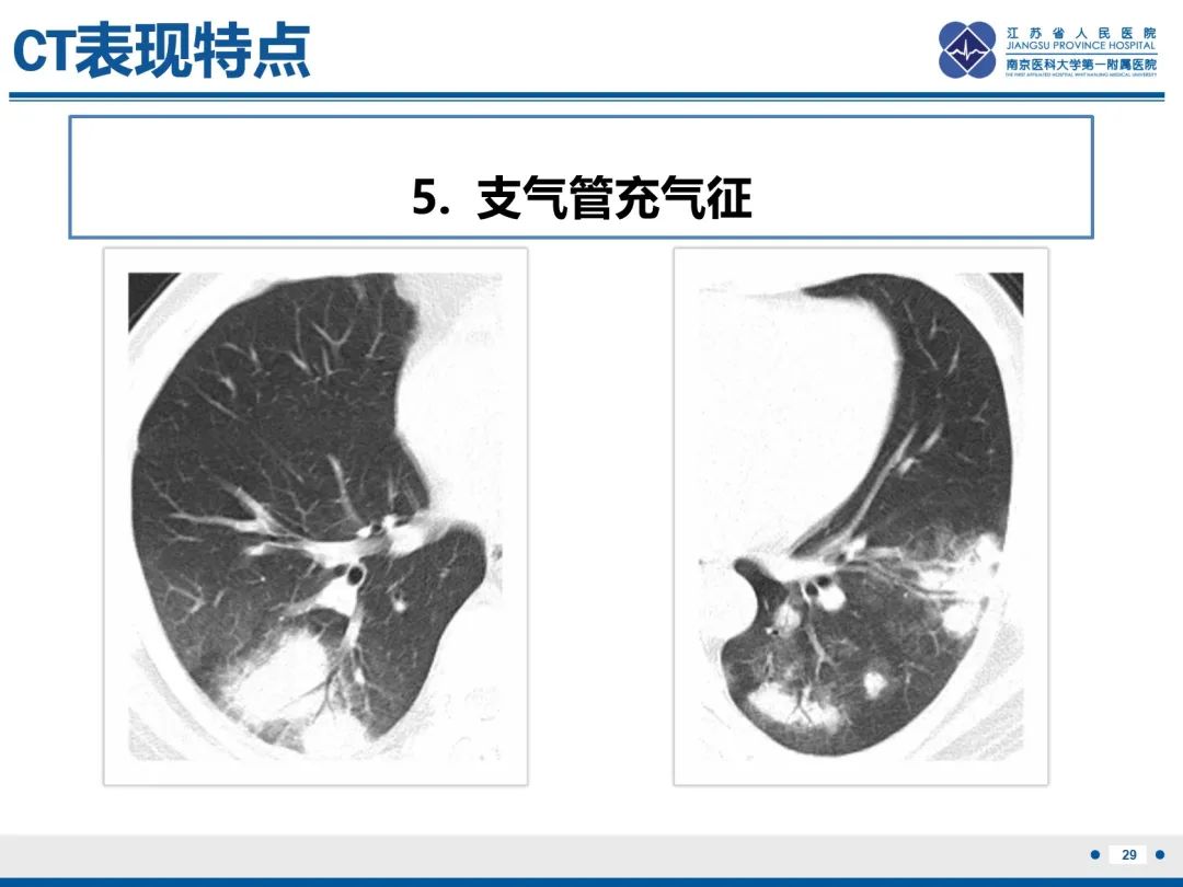 影像PPT - 【PPT】肺隐球菌病-30