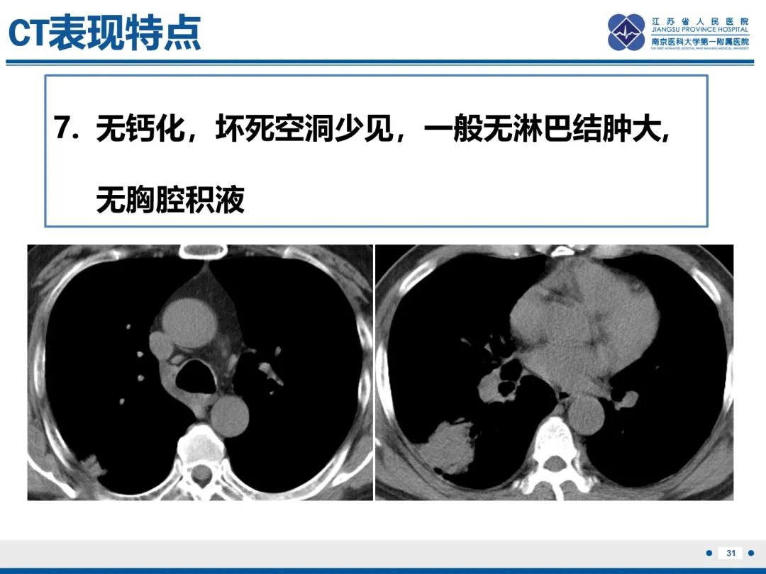 影像PPT - 【PPT】肺隐球菌病-32