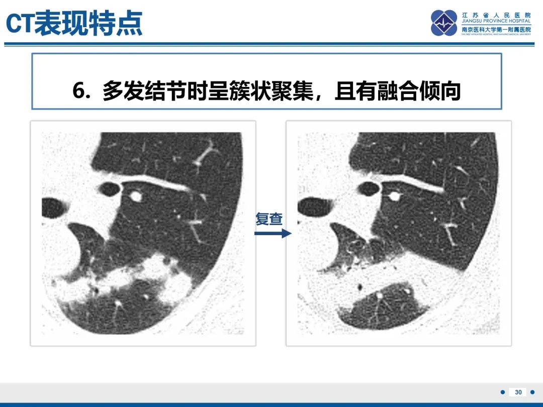 影像PPT - 【PPT】肺隐球菌病-31