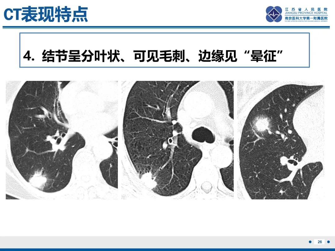 影像PPT - 【PPT】肺隐球菌病-27