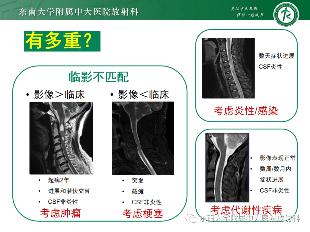 影像PPT - 【PPT】脊髓病例随访—坏死性上皮样肉芽肿炎 VS 血管母细胞瘤 VS 视神经脊髓炎谱系疾病-15 影像PPT - 【PPT】脊髓病例随访—坏死性上皮样肉芽肿炎 VS 血管母细胞瘤 VS 视神经脊髓炎谱系疾病-15