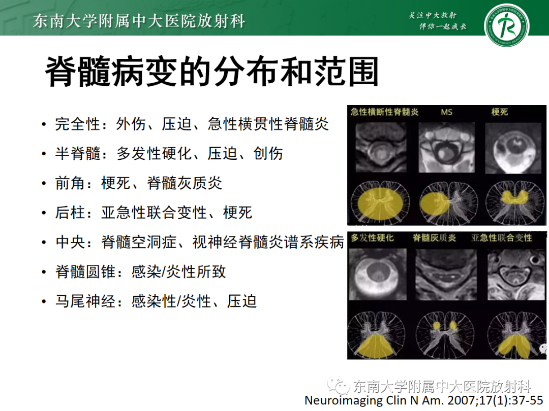 影像PPT - 【PPT】脊髓病例随访—坏死性上皮样肉芽肿炎 VS 血管母细胞瘤 VS 视神经脊髓炎谱系疾病-18 影像PPT - 【PPT】脊髓病例随访—坏死性上皮样肉芽肿炎 VS 血管母细胞瘤 VS 视神经脊髓炎谱系疾病-18