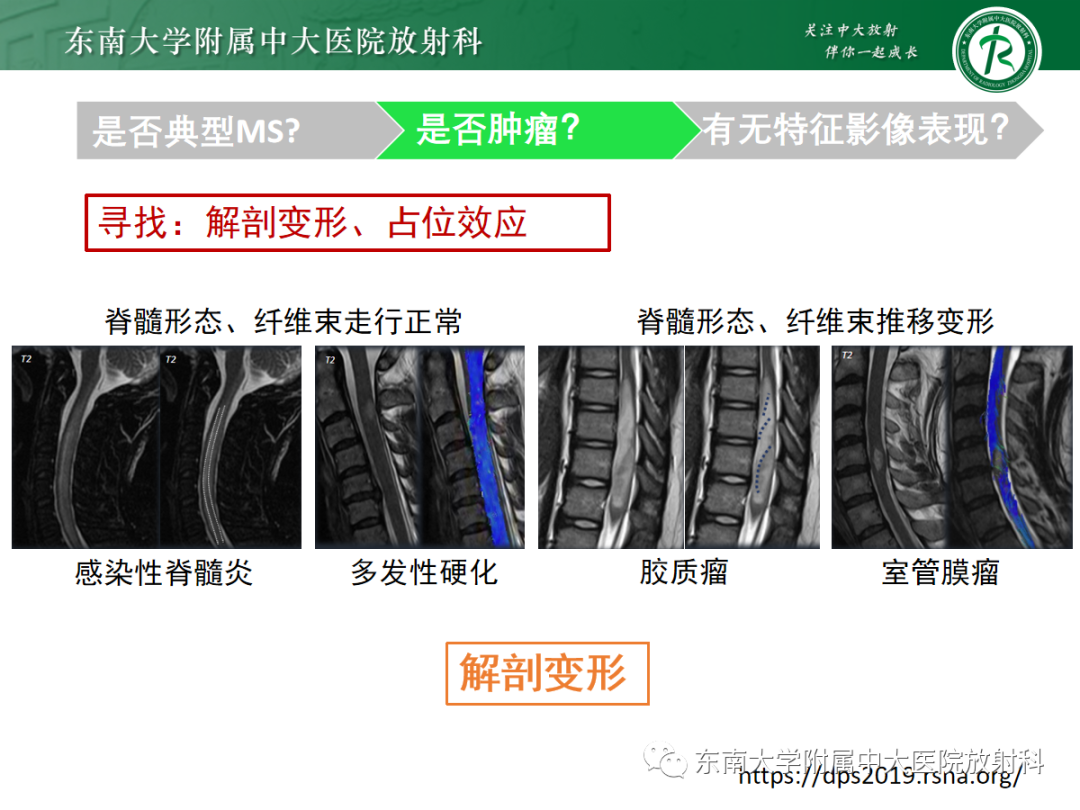 影像PPT - 【PPT】脊髓病例随访—坏死性上皮样肉芽肿炎 VS 血管母细胞瘤 VS 视神经脊髓炎谱系疾病-22 影像PPT - 【PPT】脊髓病例随访—坏死性上皮样肉芽肿炎 VS 血管母细胞瘤 VS 视神经脊髓炎谱系疾病-22