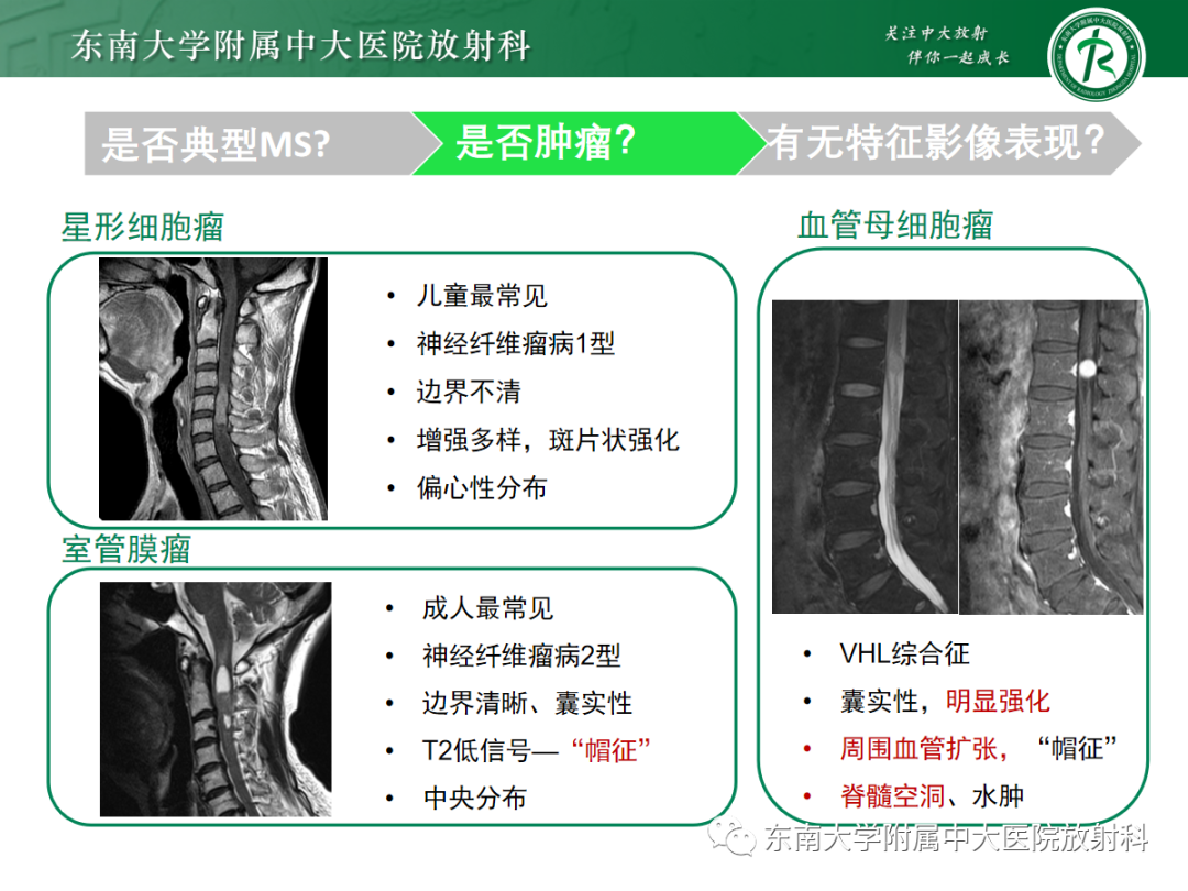 影像PPT - 【PPT】脊髓病例随访—坏死性上皮样肉芽肿炎 VS 血管母细胞瘤 VS 视神经脊髓炎谱系疾病-24 影像PPT - 【PPT】脊髓病例随访—坏死性上皮样肉芽肿炎 VS 血管母细胞瘤 VS 视神经脊髓炎谱系疾病-24