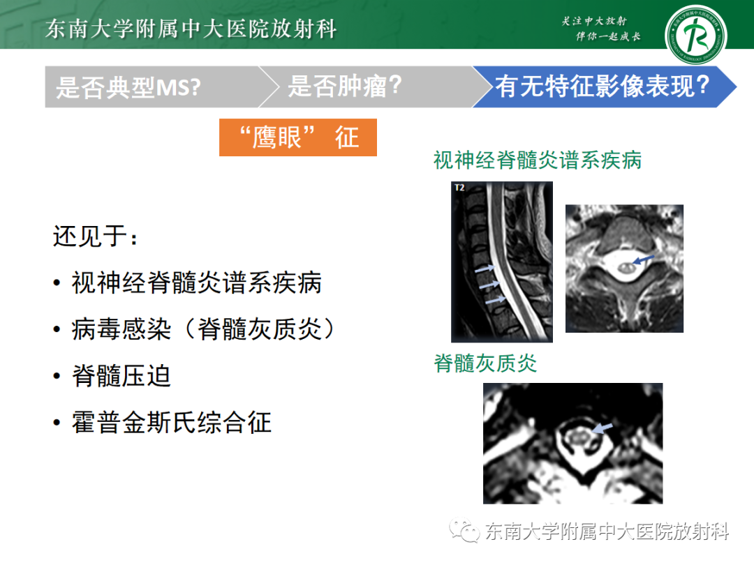 影像PPT - 【PPT】脊髓病例随访—坏死性上皮样肉芽肿炎 VS 血管母细胞瘤 VS 视神经脊髓炎谱系疾病-29 影像PPT - 【PPT】脊髓病例随访—坏死性上皮样肉芽肿炎 VS 血管母细胞瘤 VS 视神经脊髓炎谱系疾病-29