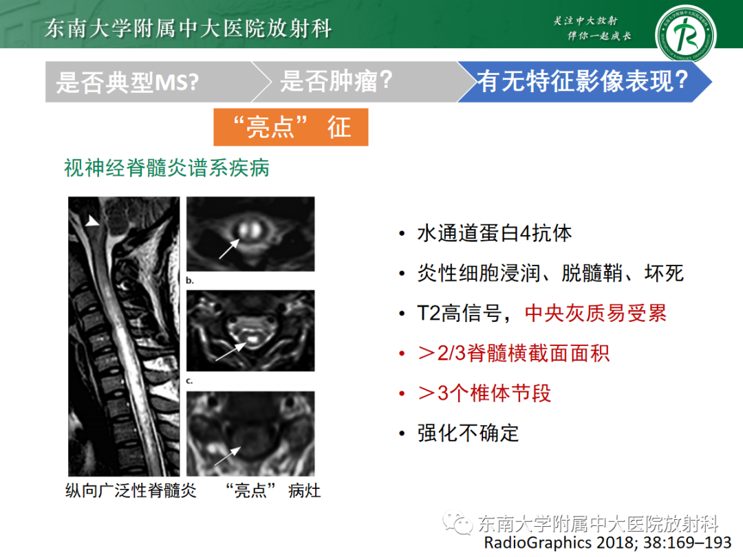 影像PPT - 【PPT】脊髓病例随访—坏死性上皮样肉芽肿炎 VS 血管母细胞瘤 VS 视神经脊髓炎谱系疾病-30 影像PPT - 【PPT】脊髓病例随访—坏死性上皮样肉芽肿炎 VS 血管母细胞瘤 VS 视神经脊髓炎谱系疾病-30