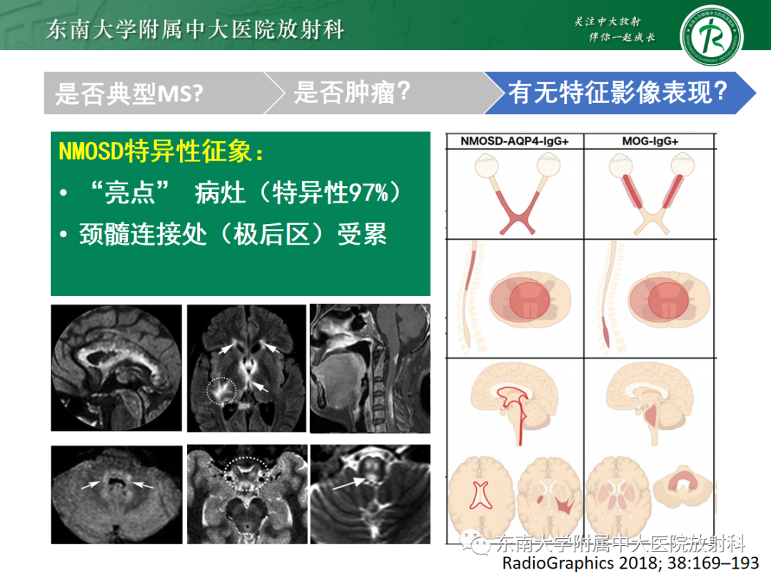 影像PPT - 【PPT】脊髓病例随访—坏死性上皮样肉芽肿炎 VS 血管母细胞瘤 VS 视神经脊髓炎谱系疾病-31 影像PPT - 【PPT】脊髓病例随访—坏死性上皮样肉芽肿炎 VS 血管母细胞瘤 VS 视神经脊髓炎谱系疾病-31