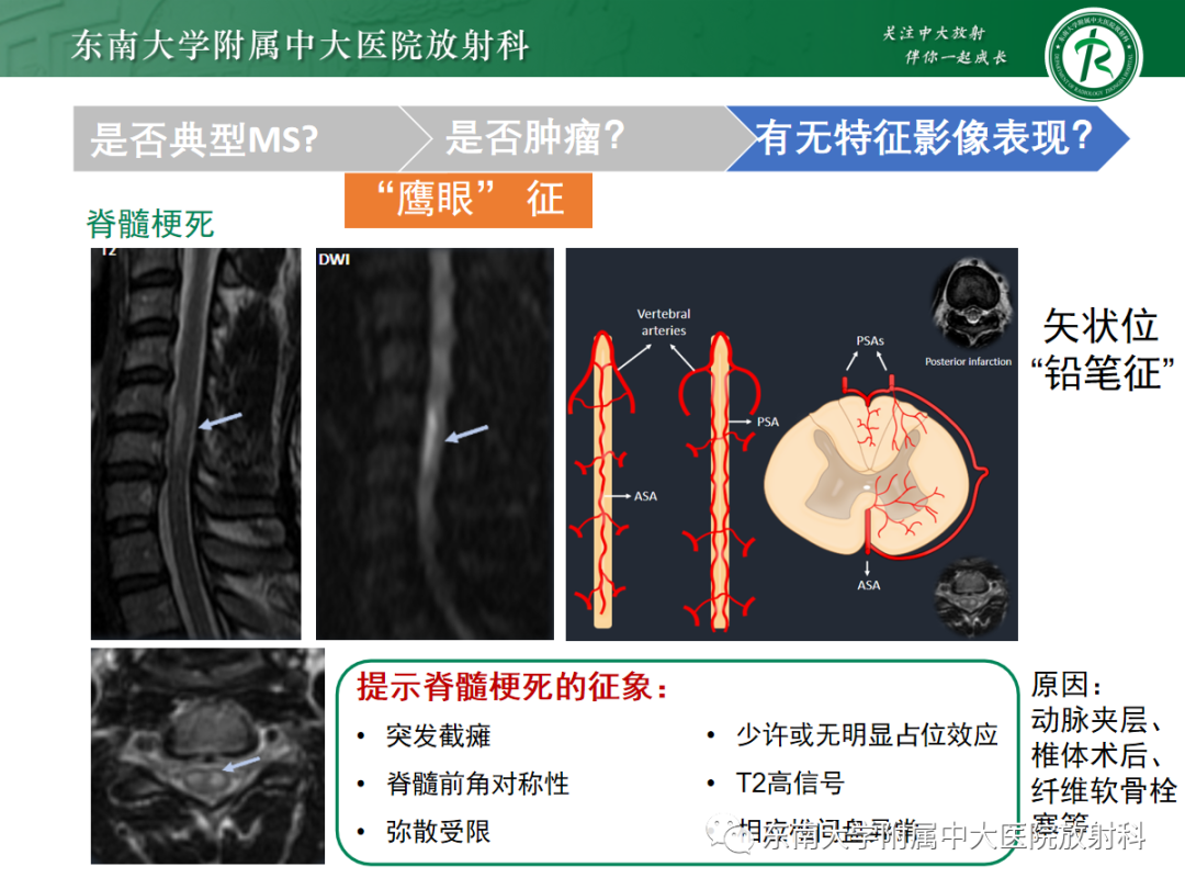 影像PPT - 【PPT】脊髓病例随访—坏死性上皮样肉芽肿炎 VS 血管母细胞瘤 VS 视神经脊髓炎谱系疾病-28 影像PPT - 【PPT】脊髓病例随访—坏死性上皮样肉芽肿炎 VS 血管母细胞瘤 VS 视神经脊髓炎谱系疾病-28