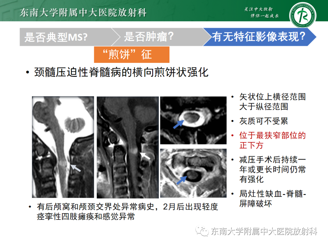 影像PPT - 【PPT】脊髓病例随访—坏死性上皮样肉芽肿炎 VS 血管母细胞瘤 VS 视神经脊髓炎谱系疾病-33 影像PPT - 【PPT】脊髓病例随访—坏死性上皮样肉芽肿炎 VS 血管母细胞瘤 VS 视神经脊髓炎谱系疾病-33