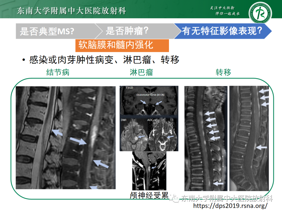 影像PPT - 【PPT】脊髓病例随访—坏死性上皮样肉芽肿炎 VS 血管母细胞瘤 VS 视神经脊髓炎谱系疾病-34 影像PPT - 【PPT】脊髓病例随访—坏死性上皮样肉芽肿炎 VS 血管母细胞瘤 VS 视神经脊髓炎谱系疾病-34