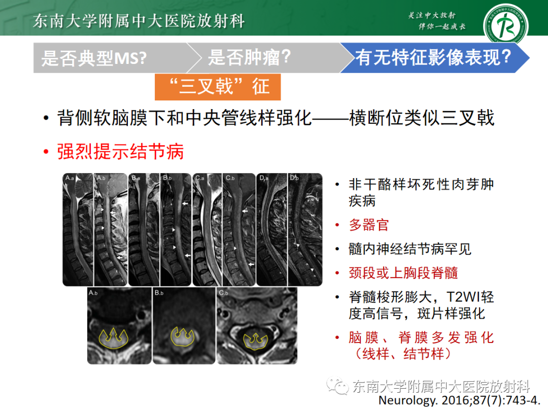 影像PPT - 【PPT】脊髓病例随访—坏死性上皮样肉芽肿炎 VS 血管母细胞瘤 VS 视神经脊髓炎谱系疾病-32 影像PPT - 【PPT】脊髓病例随访—坏死性上皮样肉芽肿炎 VS 血管母细胞瘤 VS 视神经脊髓炎谱系疾病-32
