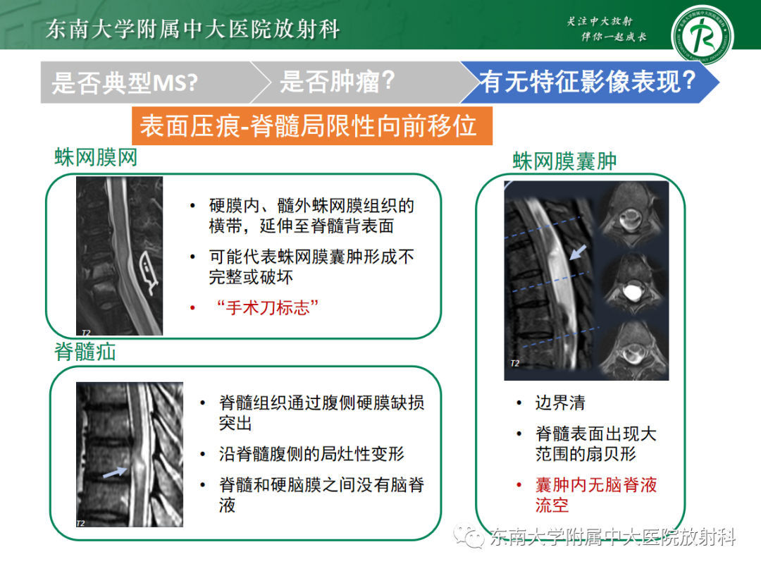 影像PPT - 【PPT】脊髓病例随访—坏死性上皮样肉芽肿炎 VS 血管母细胞瘤 VS 视神经脊髓炎谱系疾病-36 影像PPT - 【PPT】脊髓病例随访—坏死性上皮样肉芽肿炎 VS 血管母细胞瘤 VS 视神经脊髓炎谱系疾病-36