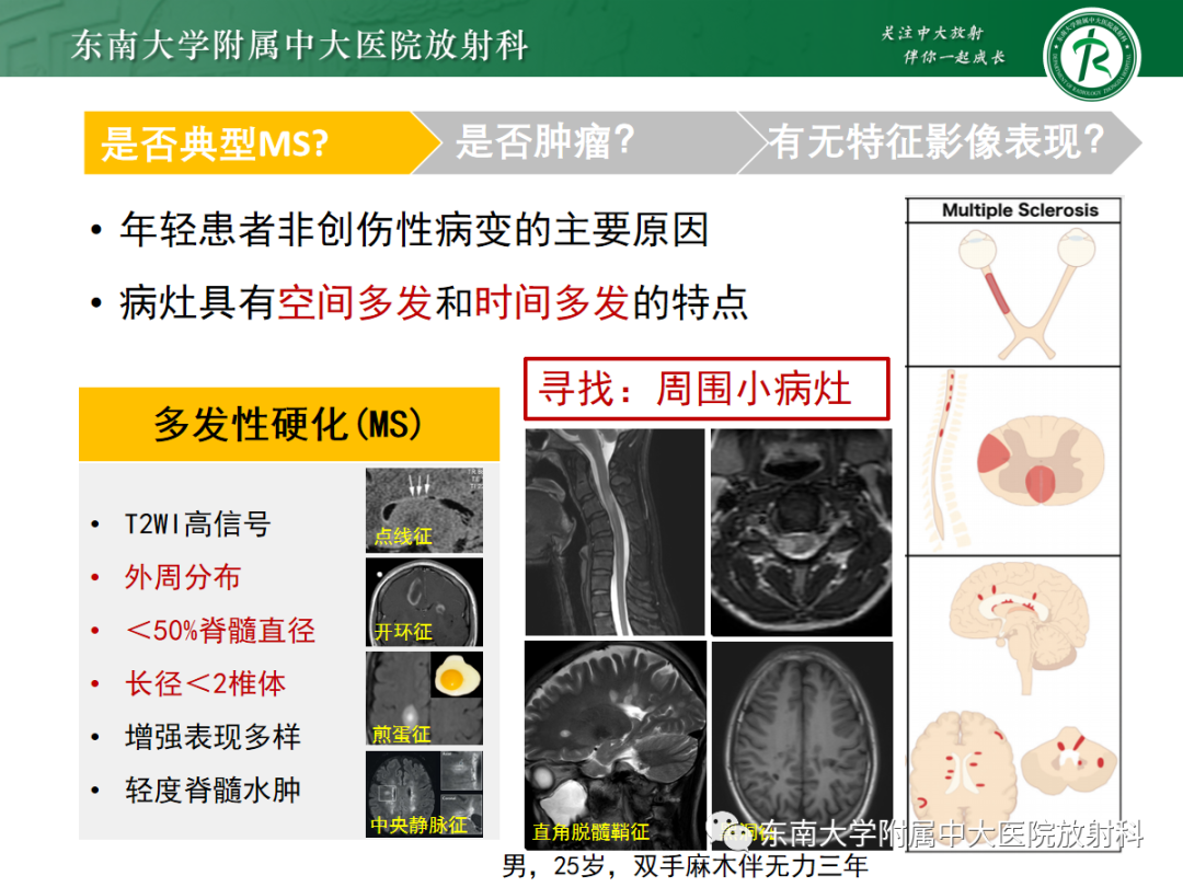 影像PPT - 【PPT】脊髓病例随访—坏死性上皮样肉芽肿炎 VS 血管母细胞瘤 VS 视神经脊髓炎谱系疾病-21 影像PPT - 【PPT】脊髓病例随访—坏死性上皮样肉芽肿炎 VS 血管母细胞瘤 VS 视神经脊髓炎谱系疾病-21