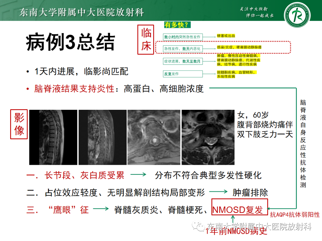 影像PPT - 【PPT】脊髓病例随访—坏死性上皮样肉芽肿炎 VS 血管母细胞瘤 VS 视神经脊髓炎谱系疾病-41 影像PPT - 【PPT】脊髓病例随访—坏死性上皮样肉芽肿炎 VS 血管母细胞瘤 VS 视神经脊髓炎谱系疾病-41