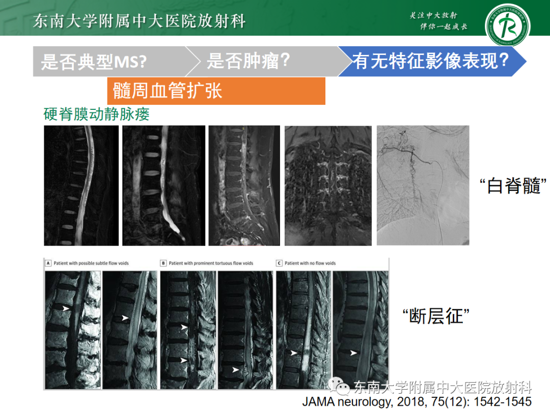 影像PPT - 【PPT】脊髓病例随访—坏死性上皮样肉芽肿炎 VS 血管母细胞瘤 VS 视神经脊髓炎谱系疾病-35 影像PPT - 【PPT】脊髓病例随访—坏死性上皮样肉芽肿炎 VS 血管母细胞瘤 VS 视神经脊髓炎谱系疾病-35