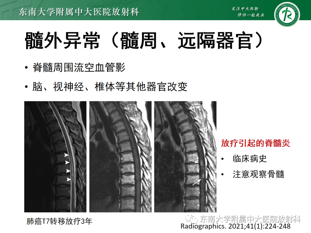 影像PPT - 【PPT】脊髓病例随访—坏死性上皮样肉芽肿炎 VS 血管母细胞瘤 VS 视神经脊髓炎谱系疾病-19 影像PPT - 【PPT】脊髓病例随访—坏死性上皮样肉芽肿炎 VS 血管母细胞瘤 VS 视神经脊髓炎谱系疾病-19