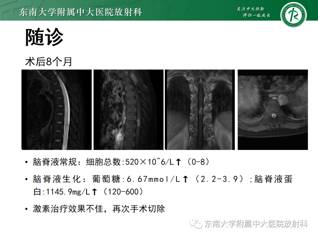 影像PPT - 【PPT】脊髓病例随访—坏死性上皮样肉芽肿炎 VS 血管母细胞瘤 VS 视神经脊髓炎谱系疾病-39 影像PPT - 【PPT】脊髓病例随访—坏死性上皮样肉芽肿炎 VS 血管母细胞瘤 VS 视神经脊髓炎谱系疾病-39