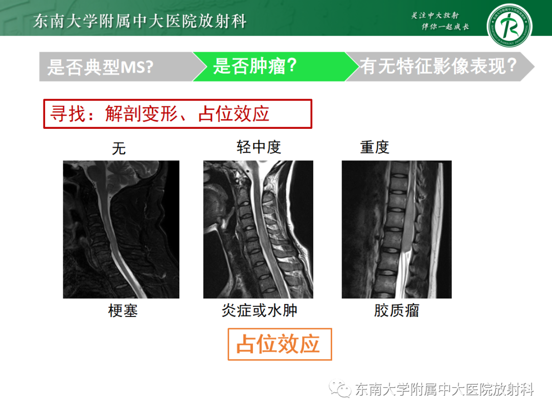 影像PPT - 【PPT】脊髓病例随访—坏死性上皮样肉芽肿炎 VS 血管母细胞瘤 VS 视神经脊髓炎谱系疾病-2 影像PPT - 【PPT】脊髓病例随访—坏死性上皮样肉芽肿炎 VS 血管母细胞瘤 VS 视神经脊髓炎谱系疾病-2