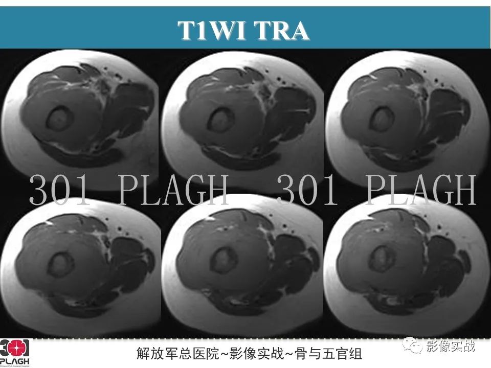 影像PPT - 【病例】股骨尤文氏肉瘤/PNET一例X线MR影像-6