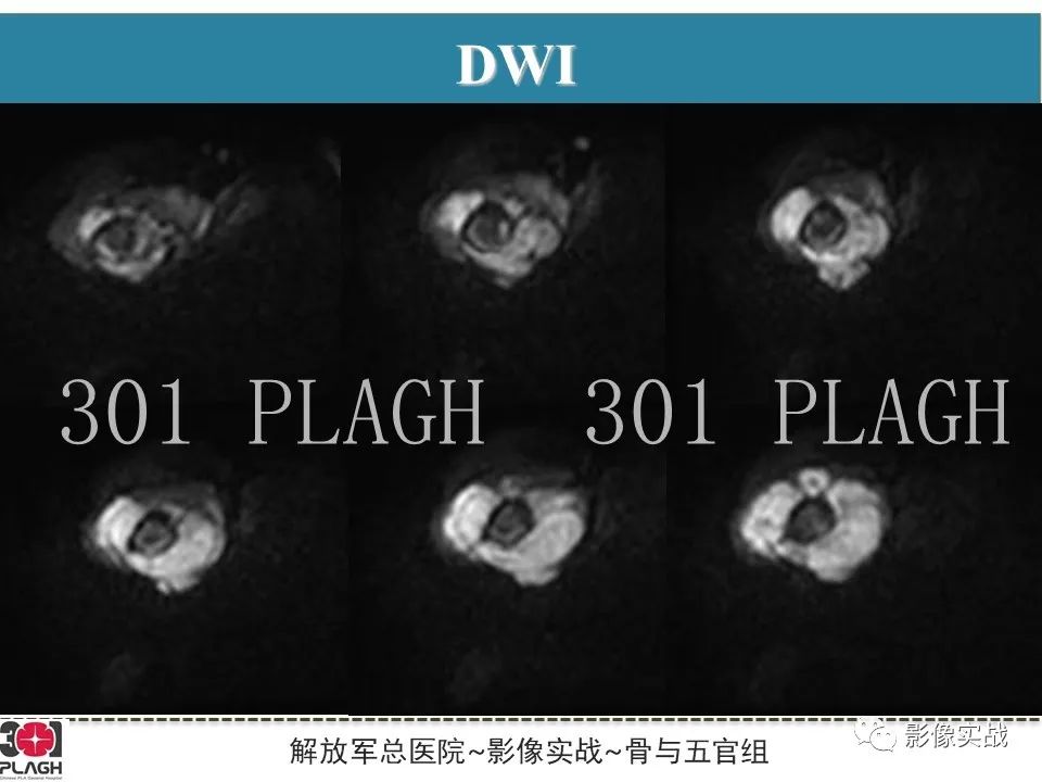 影像PPT - 【病例】股骨尤文氏肉瘤/PNET一例X线MR影像-8
