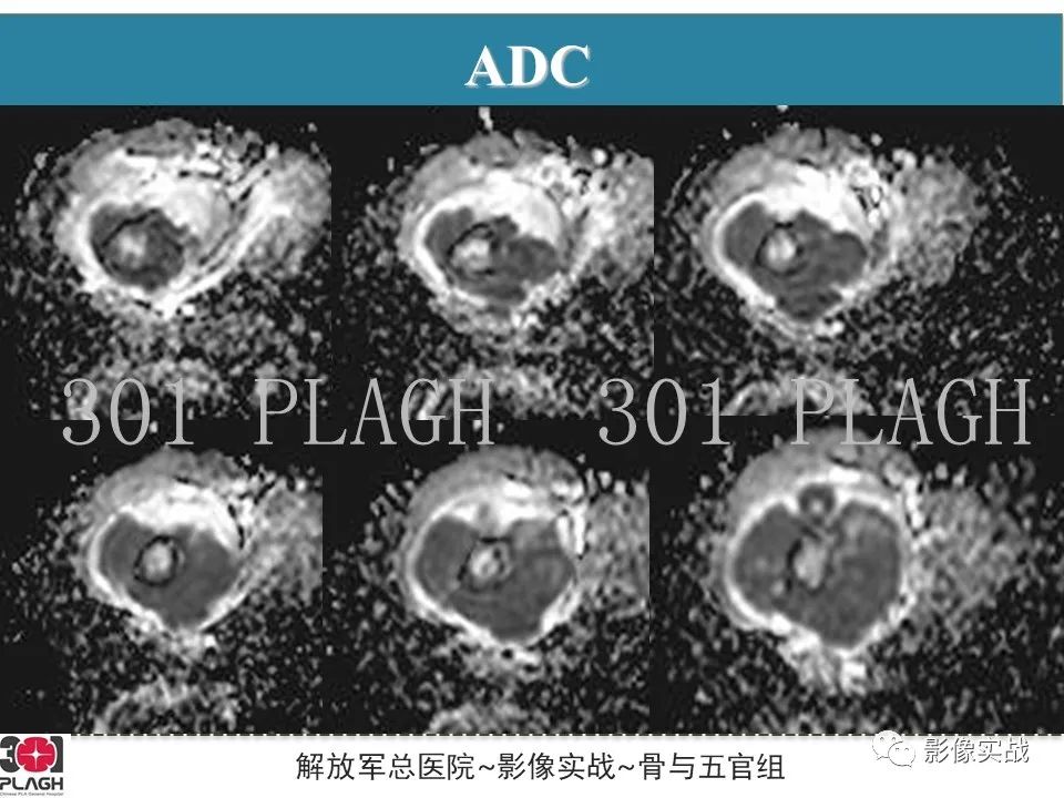 影像PPT - 【病例】股骨尤文氏肉瘤/PNET一例X线MR影像-9