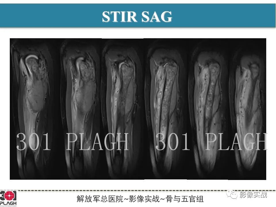 影像PPT - 【病例】股骨尤文氏肉瘤/PNET一例X线MR影像-10