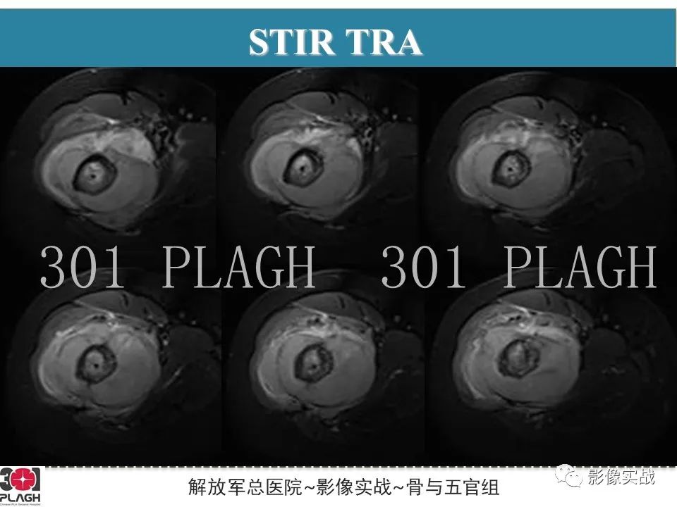 影像PPT - 【病例】股骨尤文氏肉瘤/PNET一例X线MR影像-7