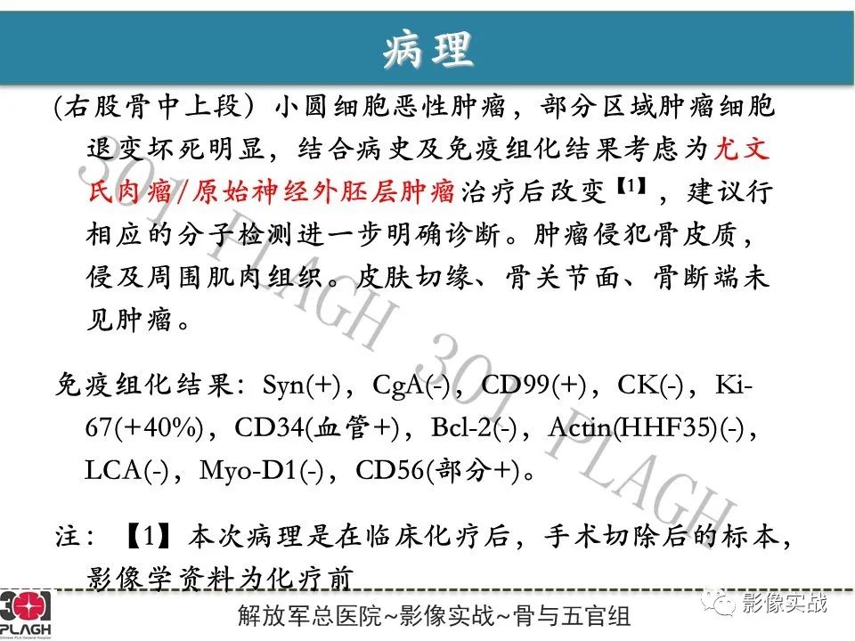 影像PPT - 【病例】股骨尤文氏肉瘤/PNET一例X线MR影像-12