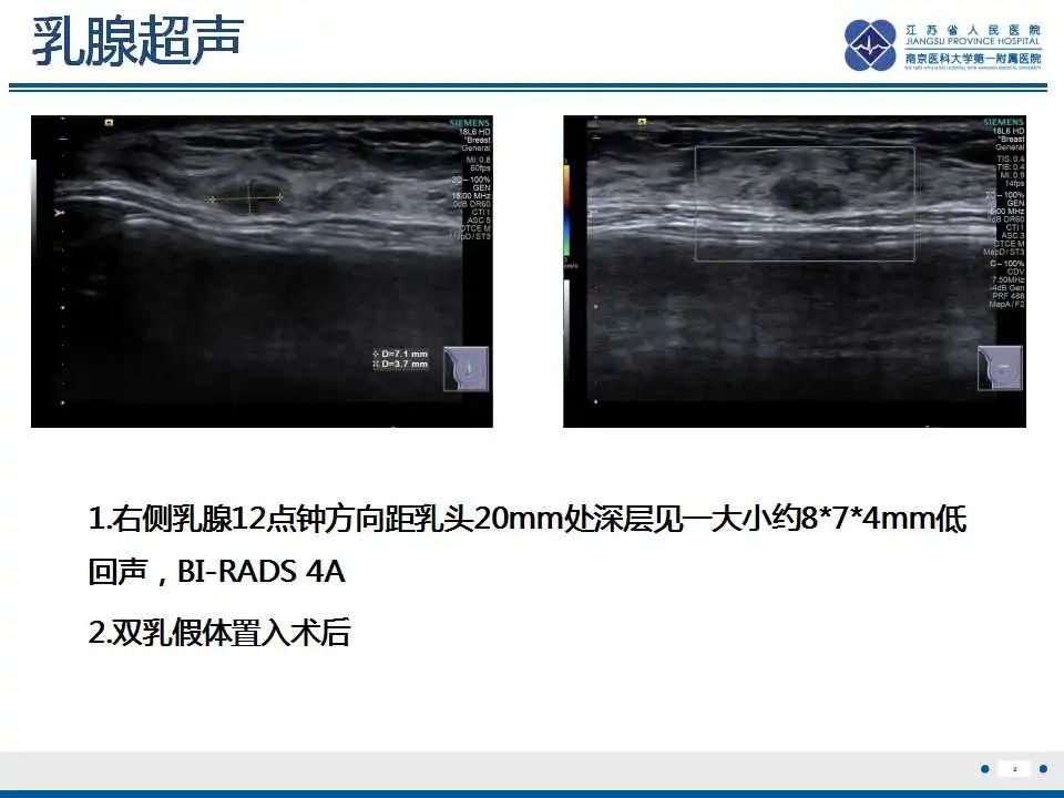 影像PPT - 【PPT】乳腺硅胶假体破裂-3