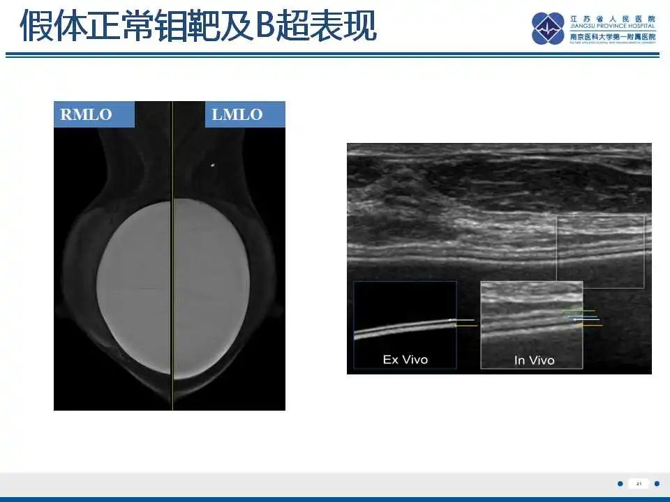 影像PPT - 【PPT】乳腺硅胶假体破裂-22