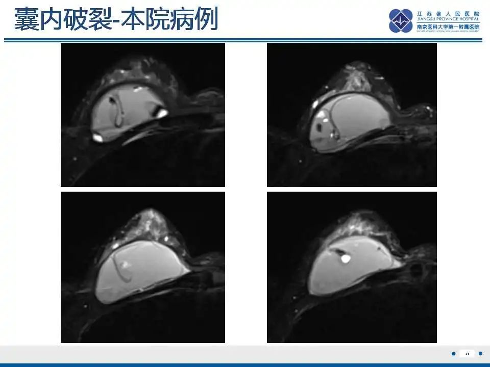 影像PPT - 【PPT】乳腺硅胶假体破裂-36