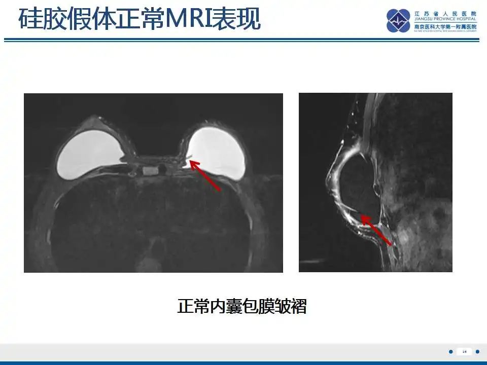 影像PPT - 【PPT】乳腺硅胶假体破裂-26
