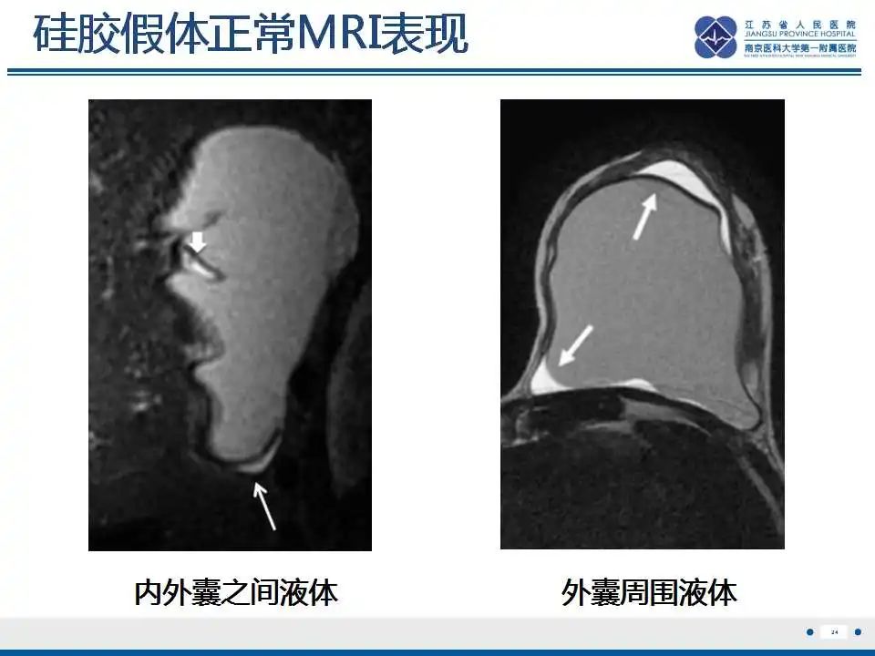 影像PPT - 【PPT】乳腺硅胶假体破裂-25
