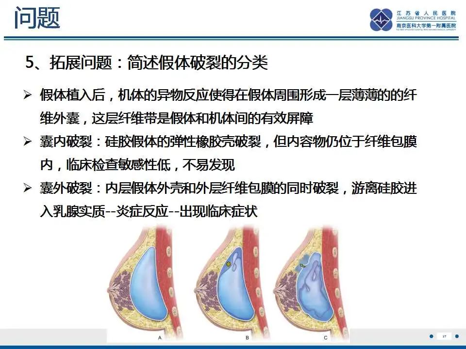 影像PPT - 【PPT】乳腺硅胶假体破裂-28