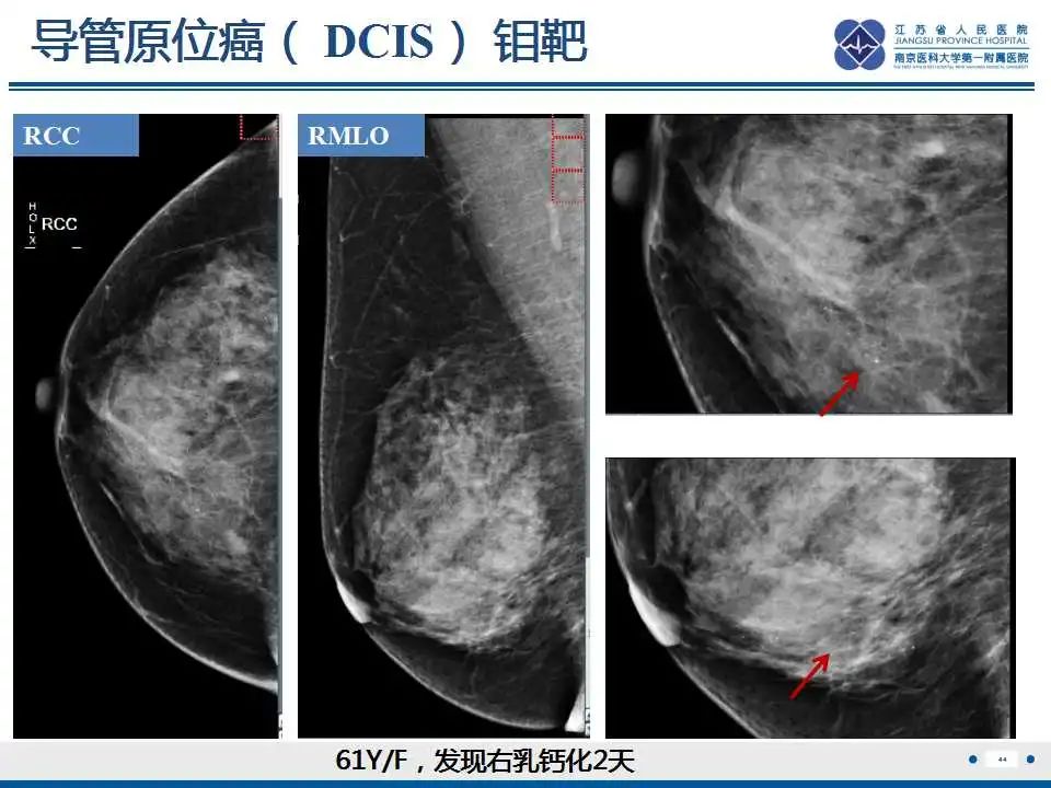 影像PPT - 【PPT】乳腺硅胶假体破裂-45