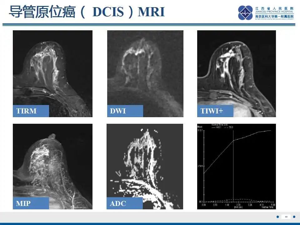 影像PPT - 【PPT】乳腺硅胶假体破裂-46