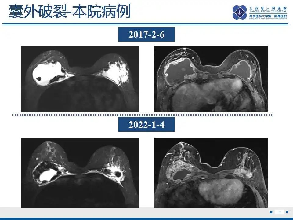 影像PPT - 【PPT】乳腺硅胶假体破裂-41