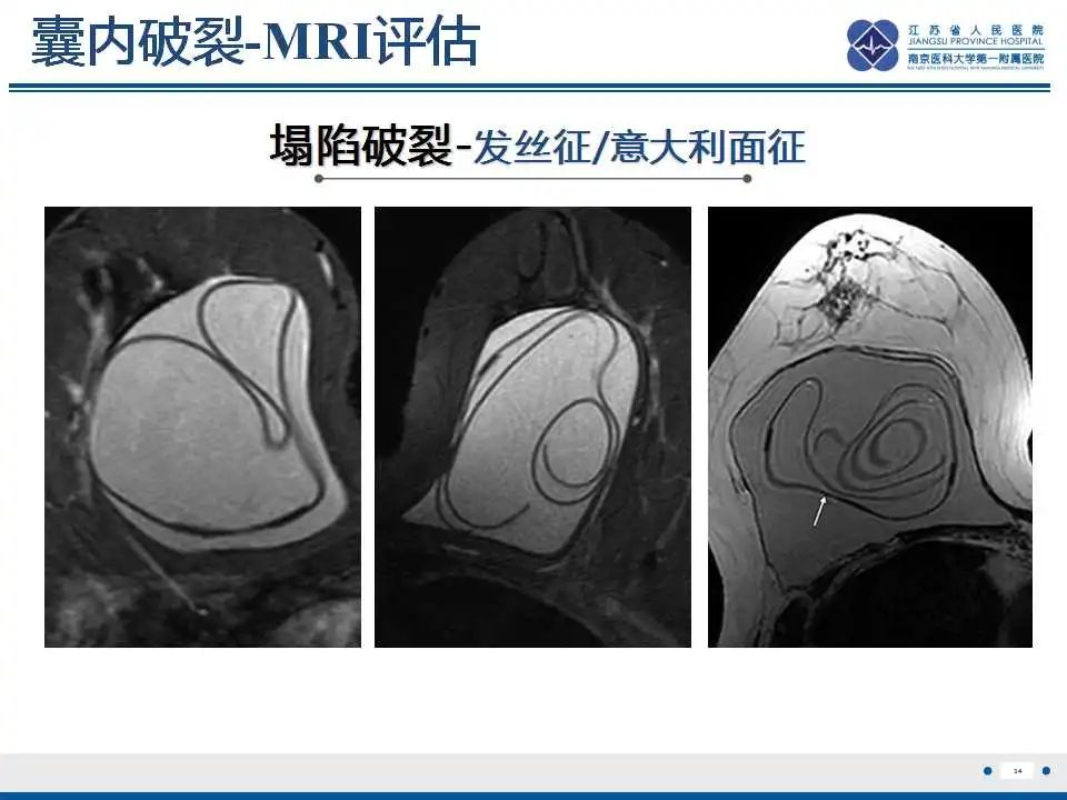 影像PPT - 【PPT】乳腺硅胶假体破裂-35
