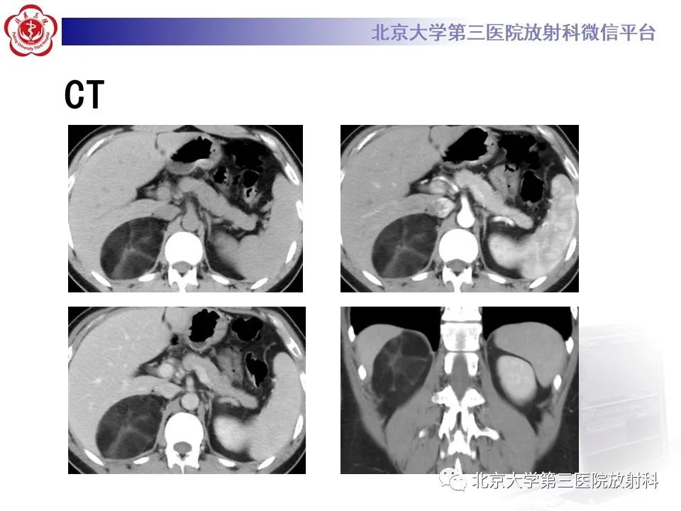影像PPT - 【PPT】肾上腺髓样脂肪瘤-3