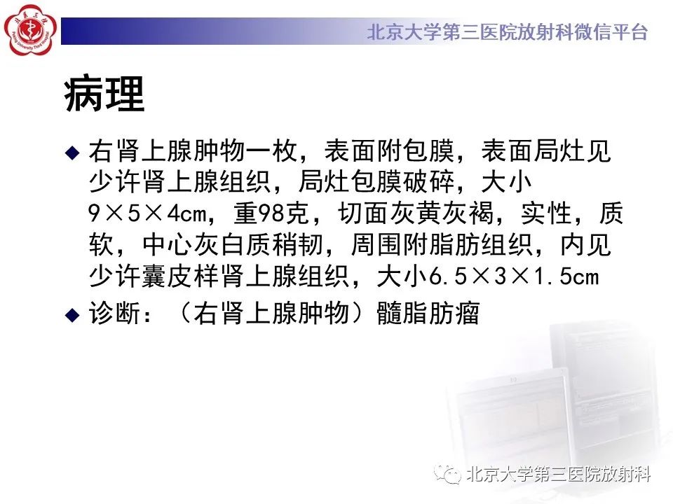 影像PPT - 【PPT】肾上腺髓样脂肪瘤-7
