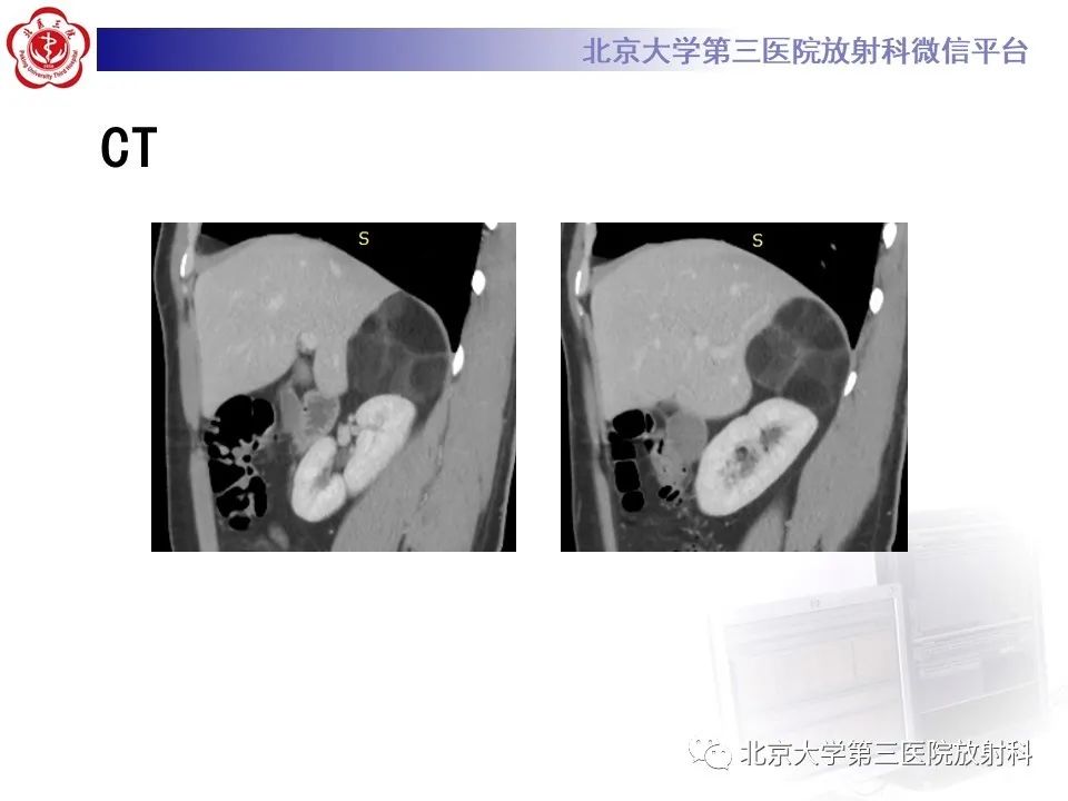 影像PPT - 【PPT】肾上腺髓样脂肪瘤-5