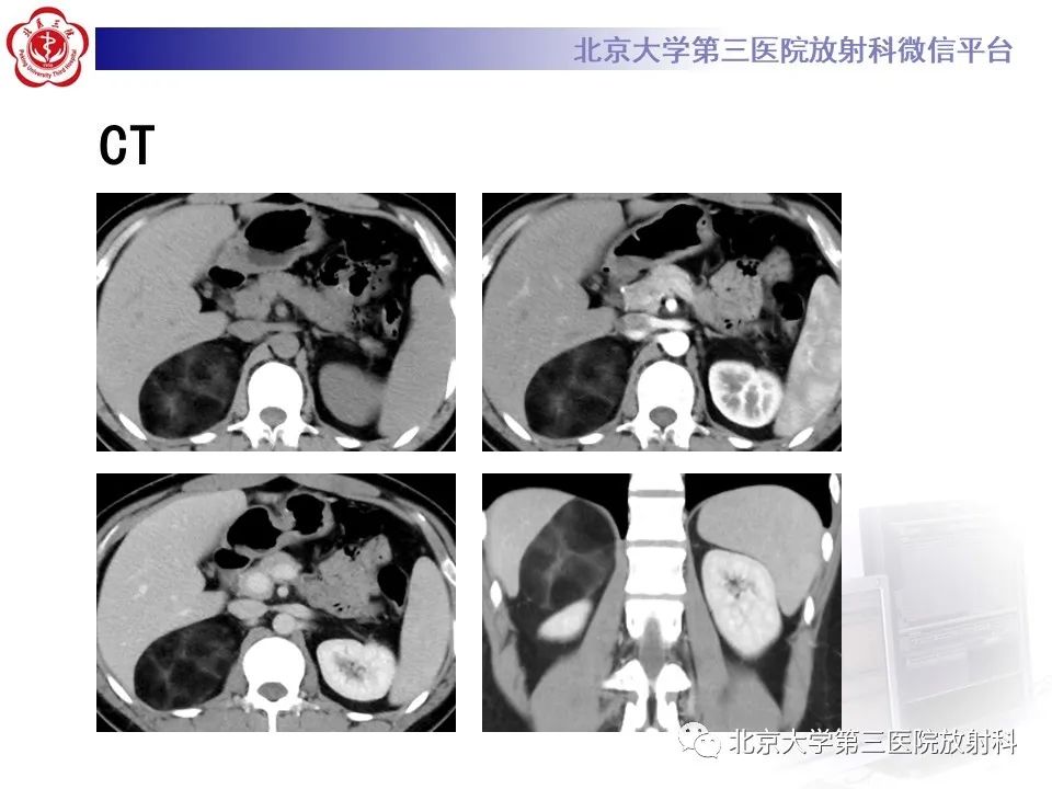 影像PPT - 【PPT】肾上腺髓样脂肪瘤-4