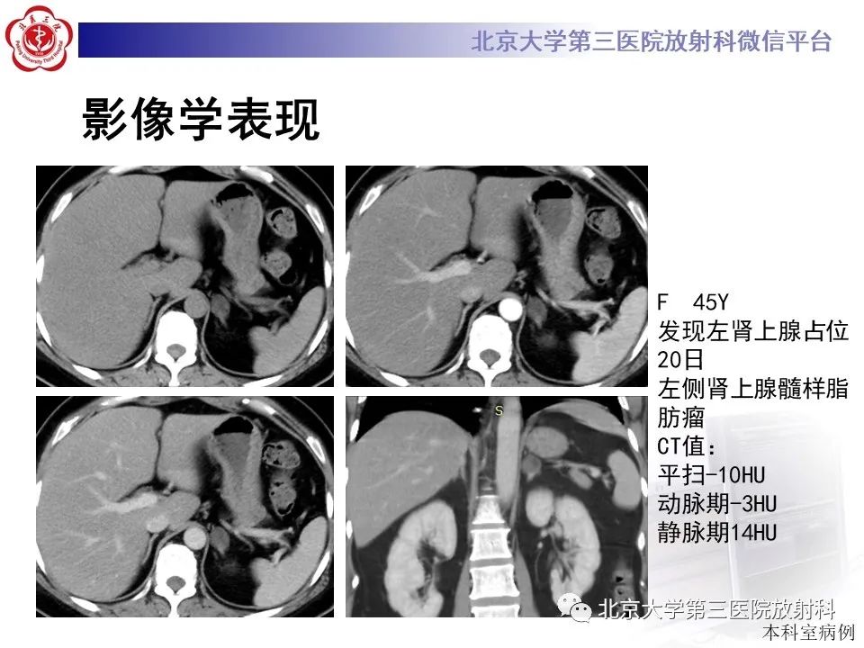 影像PPT - 【PPT】肾上腺髓样脂肪瘤-19
