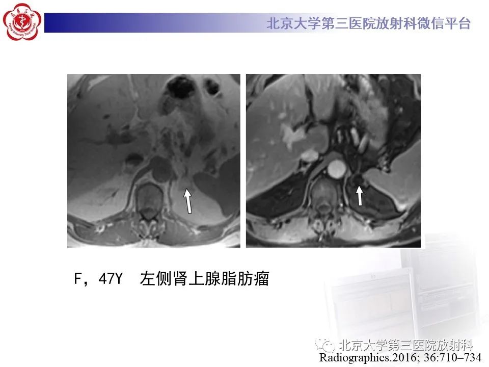影像PPT - 【PPT】肾上腺髓样脂肪瘤-25