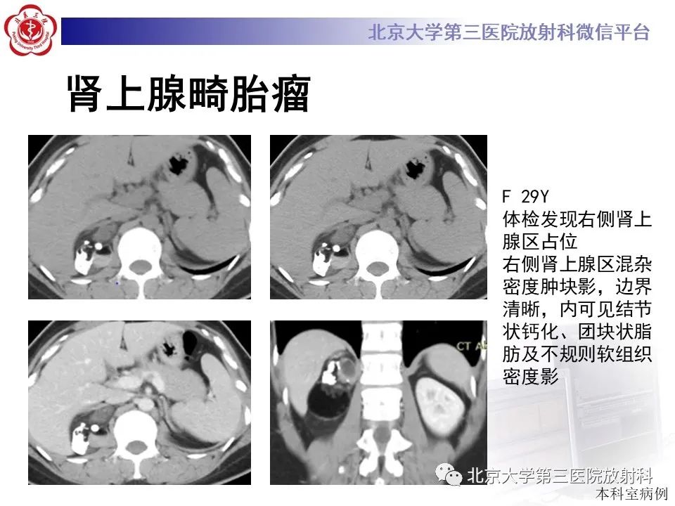 影像PPT - 【PPT】肾上腺髓样脂肪瘤-22